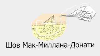 Шов Мак Миллана Донати