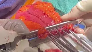 Video Correspondence Closure of Loop Ileostomy: how we do it