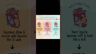Cardiomyopathy