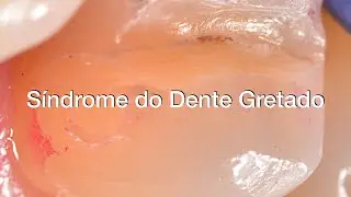 Síndrome do Dente Gretado