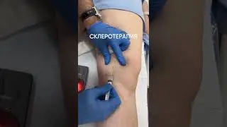 Исчезают сосудистые сеточки на ногах😧 #ташкент