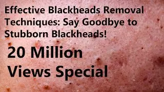 Effective Blackheads Removal Techniques: Say Goodbye to Stubborn Blackheads!