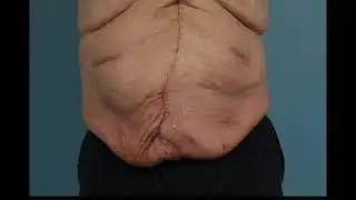 Soft tissue handling for hernias