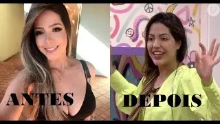 Lais Antes e Depois  - Harmonização Facial