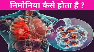 निमोनिया कैसे होता है।। डबल निमोनिया कैसे होता है।।निमोनिया के लक्षण उपचार