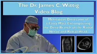 Meticulous Dissection of Forearm Fatty Mass Encompassing the Deep Branch of the Radial Nerve