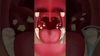 asmr tonsil stone removal animation 
