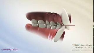 Deep Bite