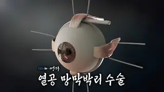 [명의 의학백과📖] 열공 망막박리 수술