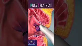 Piles Treatment 