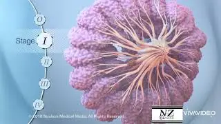 Nurses Zone(documentary)-by-Chipo James Mainda=Breast cancer (HD Version)
