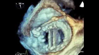 Percutaneous Mitral Para-Valvular Leak Closure (3D-TEE)