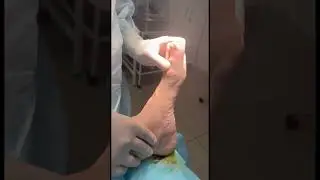 Есть #hallux #valgus , на видео #rigidus. Это видео до коррекции #массаж #доктор #massage #юмор #нов