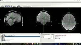 Normalization to the MNI Space and Smoothing | SPM | Resting-State fMRI | Preprocessing | MATLAB