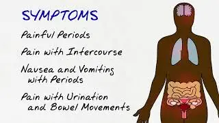 Endometriosis Explained | Main Line Health