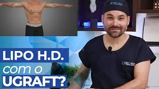 UGRAFT NA LIPO HD O que é e como funciona?