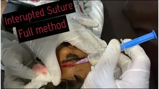 Interupted sutures||Basic method of suturing #suturingmethod #doctorslife #interuptedsutur #medvlog