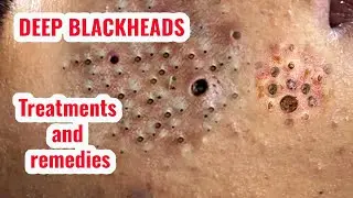 Deep blackheads: Treatments and remedies