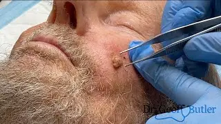 Removal of a Basal Cell Cancer on the face