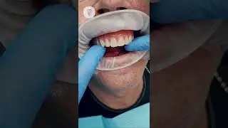 For a completely edentulous jaw, a denture on a bar and an all-on-4 denture underneath. Dental im...