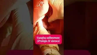 Uşaqlıq sallanması