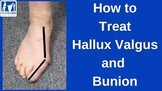 How to Treat Hallux Valgus and Bunion