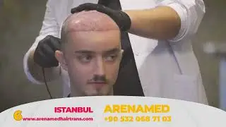 Cuales son las mejores clínicas de Trasplante Capilar en Turquía?