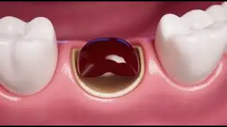 🦷 Blood Clot After Tooth Extraction — Why It Matters