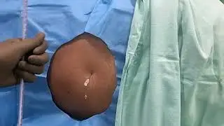 CSF Opening Pressure measurement II Intracranial Pressure