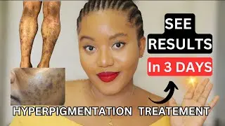 HOW TO FADE HYPERPIGMENTATION FAST 💨 | COMPLETE BODY KIT + FULL ROUTINE