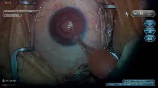 Surgery: Basics of Phacoemulsification: Cortex Removal (Part 5/6)