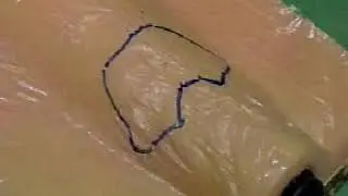 Tracheostomy Cpsp