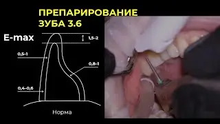 ПРЕПАРИРОВАНИЕ ВИТАЛЬНОГО 3.6 ЗУБА РАБОТА В МИКРОСКОП (полный гайд)
