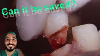 Tooth Broken in Half After an Accident Getting Reattached at the Dental Office.