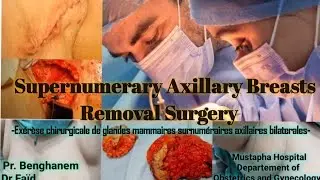 Axillary Breast Removal Surgery/ Exérèse chirurgicale de Glandes mammaires surnuméraires axillaires