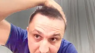 Кандидоз у веганов-сыроедов, поэтому я ушёл с веганства. Сыроедение/веганство вред? 