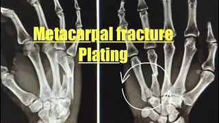 Metacarpal fracture plating #hand #bone #fracture #handsurgery #metacarpal surgeon #raipur