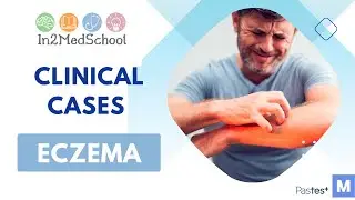 Eczema Clinical Case