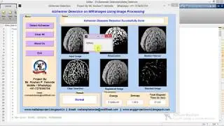 Alzhemier Diseases Detection on MRI Images Using Image Processing Matlab Code IEEE Project