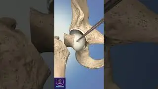 Hip Replacement Anterior Surgery 