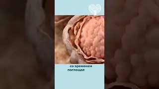 Может ли киста перерасти в рак? #онколог #онкологиягруди #киста