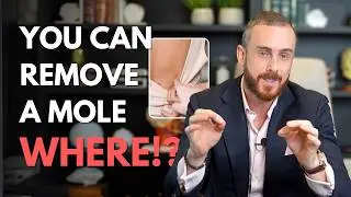 Where Can You Remove a Mole? Here’s What You Need to Know