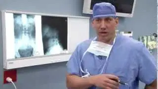 Candidates for Spinal Fusion Surgery