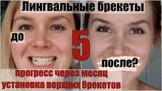 Эпизод 5: про установку верхних брекетов и прогресс через месяц