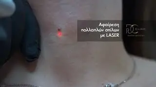 Αφαίρεση σπίλων με LASER