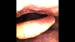 Early glottic cancer