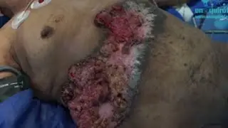 Carcinoma de células escamosas abdominal