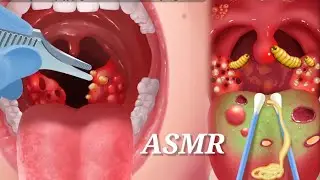 ASMR Inside Infected Mouth Clean/ Remove Back Infection ‎@ASMRanimation1234
