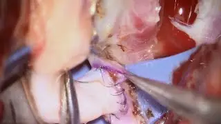 A1-RAG-M2 Intracranial-Intracranial Interpositional Bypass & Trapping of a Recurrent M1 MCA Aneurysm