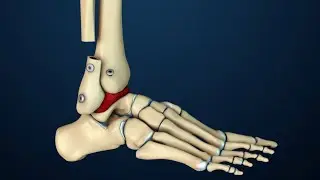 Fusión lateral transfibular de tobillo